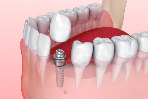 Full Implant Services